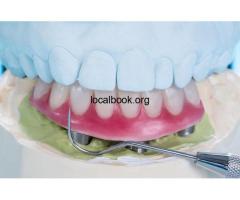 How Long Do Implant-Supported Overdentures Last? - 3
